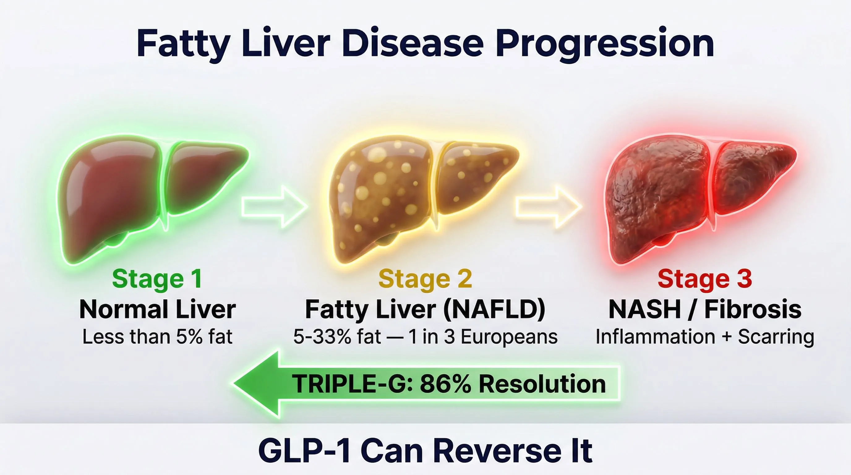 Fatty liver infographic: progression from healthy to NAFLD to NASH and GLP-1 reversal